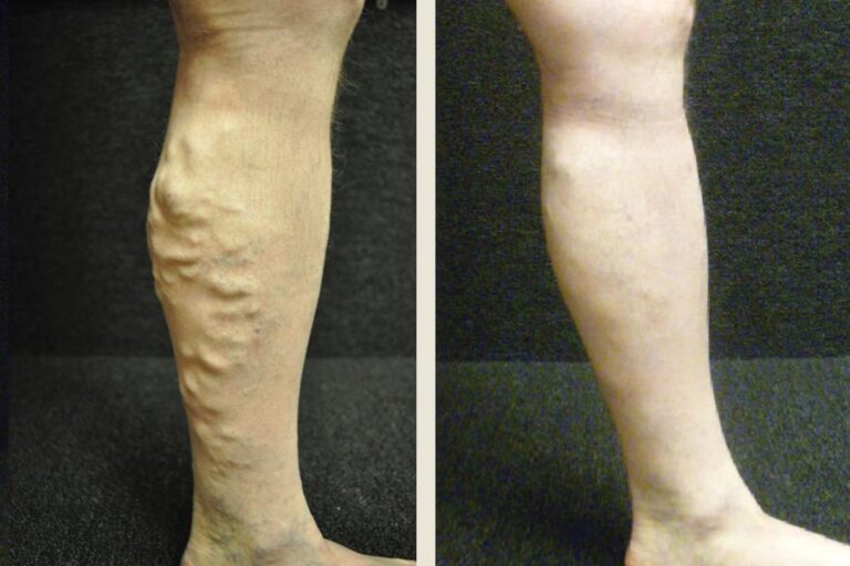 EVLT-Sclero-70yo-M-ba