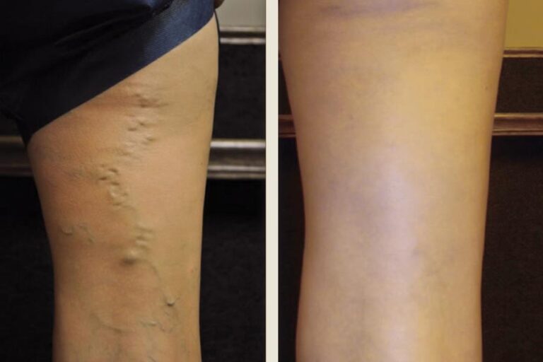 Sclerotherapy-35yo-F-ba