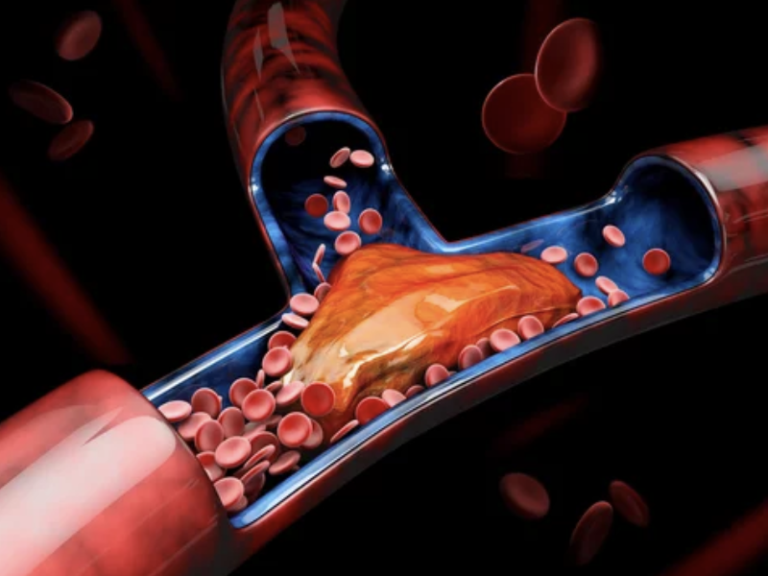 Deep Vein Thrombosis: The Deeper Impact on Your Health