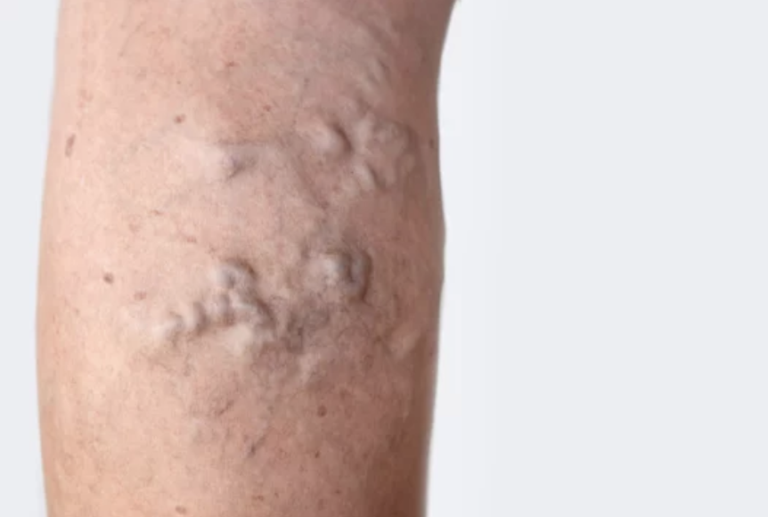 Why do we have Varicose Veins?