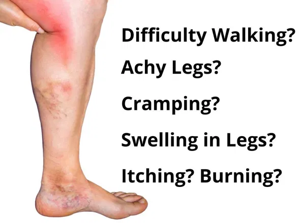 Do You Have Vein Disease?